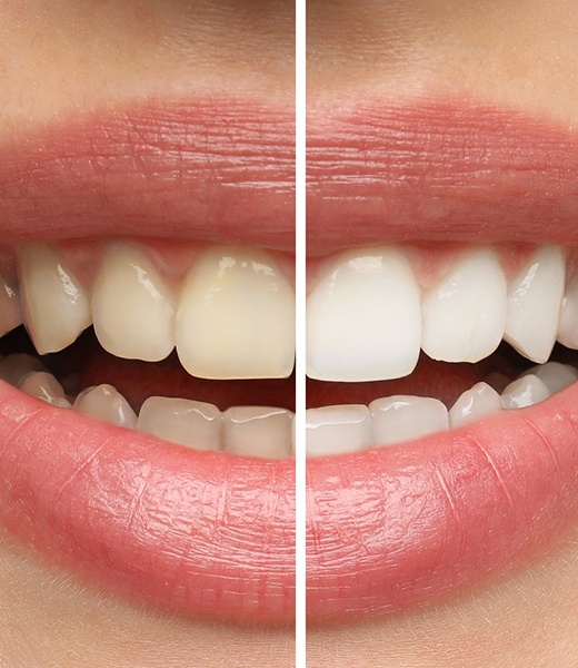 Closeup of a smile that’s halved to show before/after whitening results